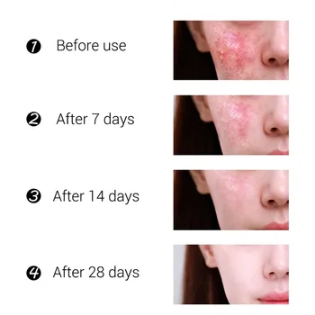 Anti-akne krema za zdravljenje smetano blackhead akne krema za popravilo gel olje nadzor skrči pore brazgotina nega obraza za beljenje kože, 30 g