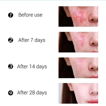 Učinkovito Akne Removal Cream Zdravljenje Aken Zbledi Akne Madeži Olja Nadzor Skrči Pore Zob Rumene, Akne Kreme Za Nego Kože